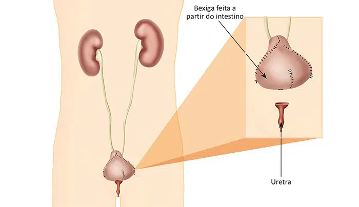 Tratamento do câncer de Bexiga