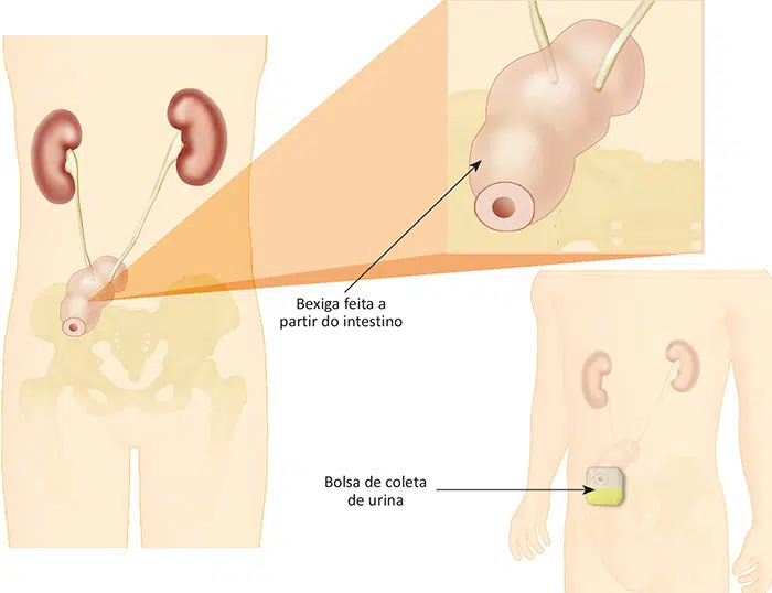 Tratamento do câncer de Bexiga