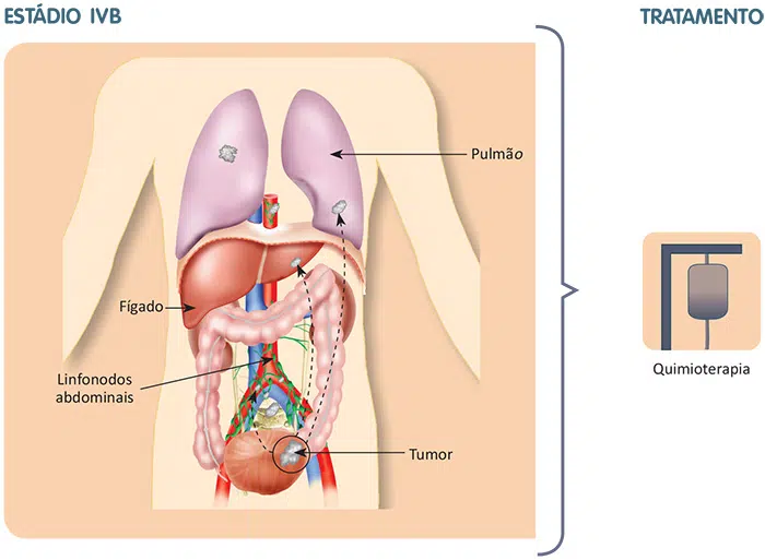 Tratamento do câncer de Bexiga