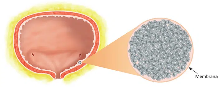 O que é câncer de bexiga