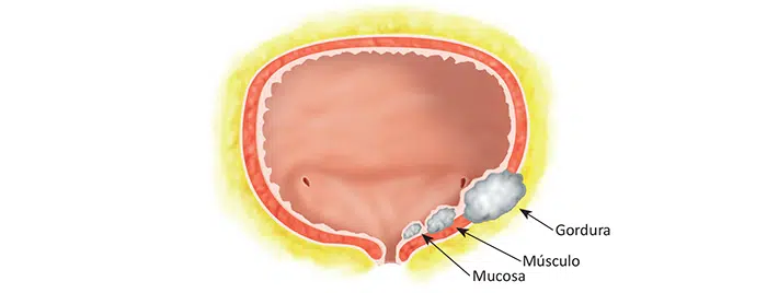 O que é câncer de bexiga