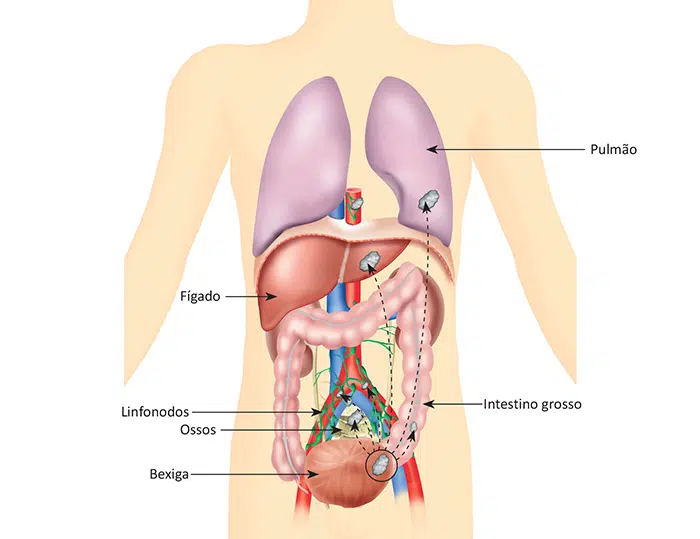 O que é câncer de bexiga
