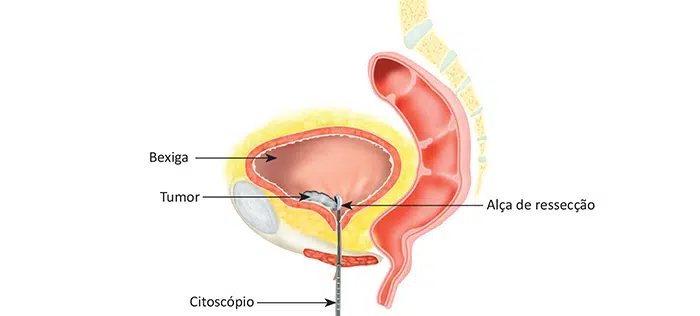 Tratamento do câncer de Bexiga