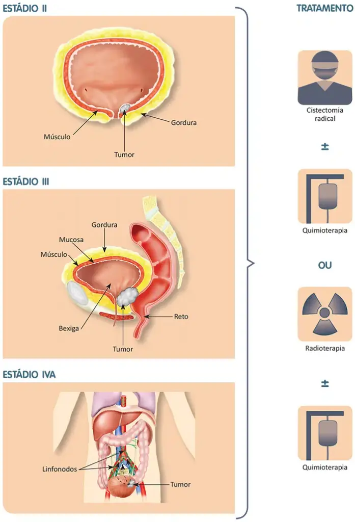 Tratamento do câncer de Bexiga