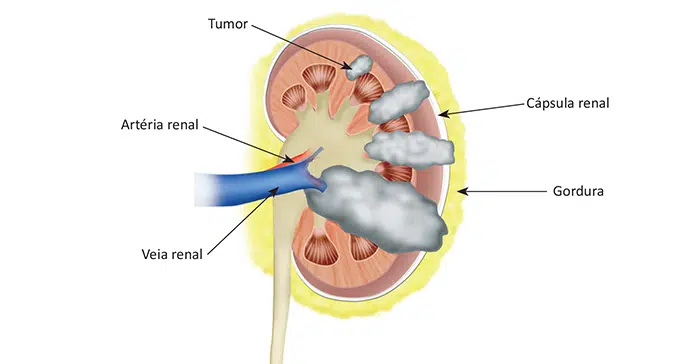 O que é câncer de rim?