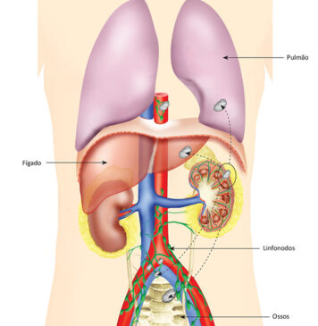 O que é câncer de rim?