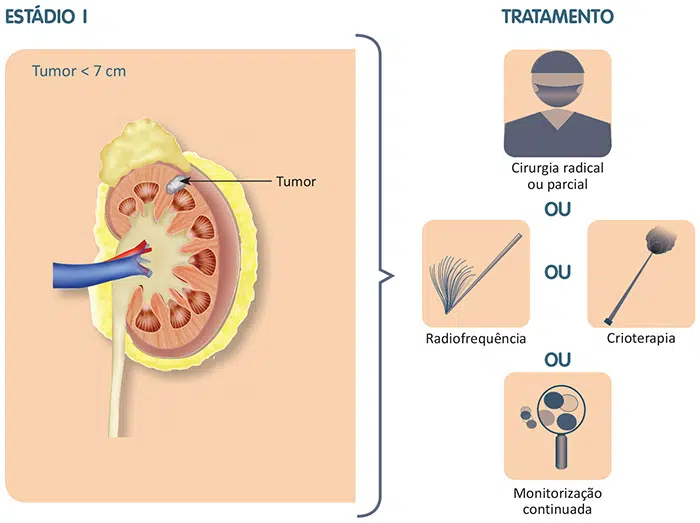Tratamento do câncer de rim