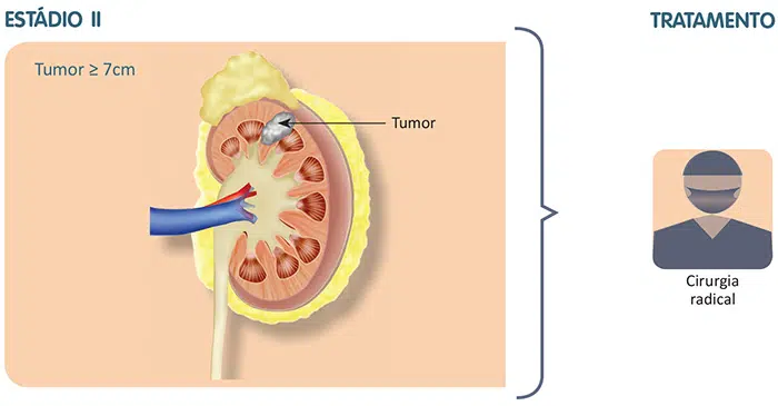 Tratamento do câncer de rim