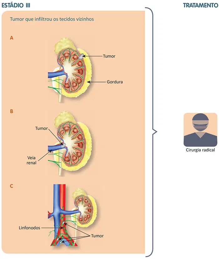 Tratamento do câncer de rim
