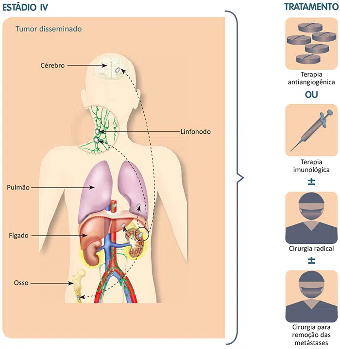 Tratamento do câncer de rim