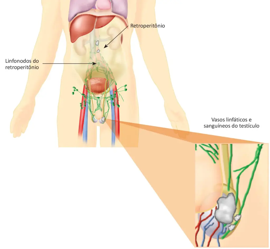 O que é câncer de testículo?