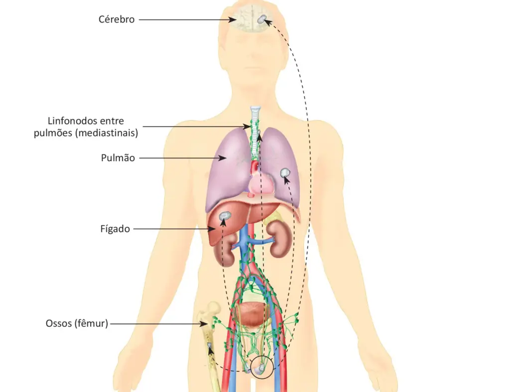 O que é câncer de testículo?