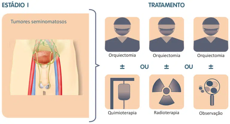 Tratamento do câncer de testículo