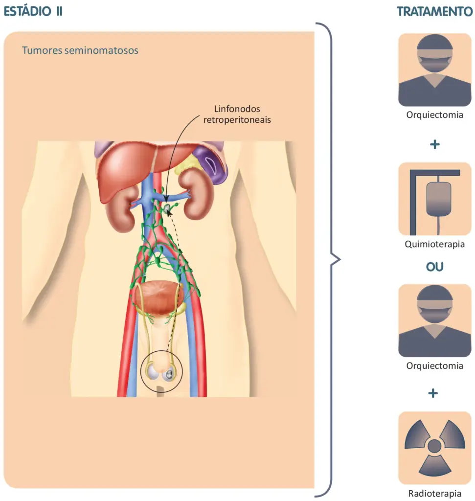 Tratamento do câncer de testículo