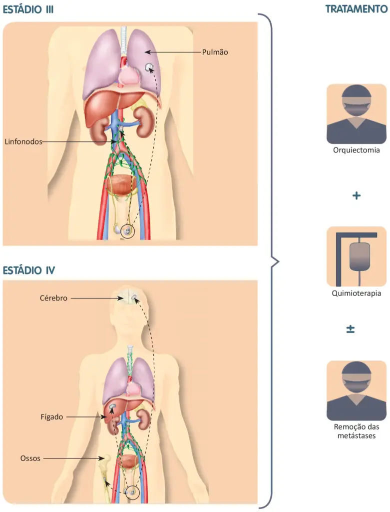 Tratamento do câncer de testículo