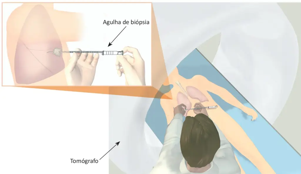 Diagnóstico do câncer de pulmão