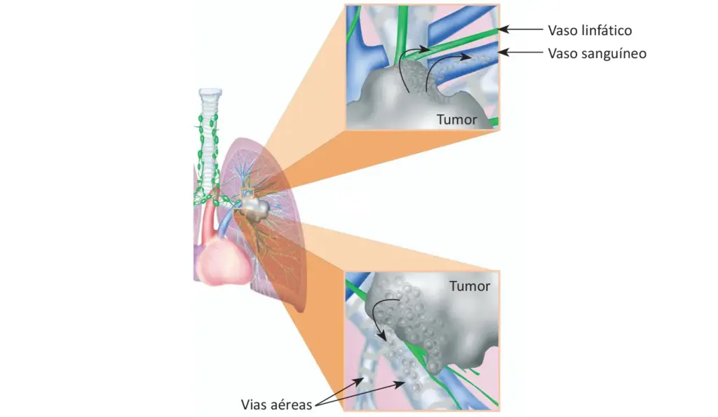 O que é câncer de pulmão?