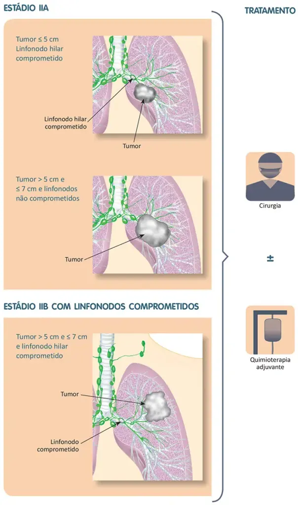 Tratamento do câncer de pulmão
