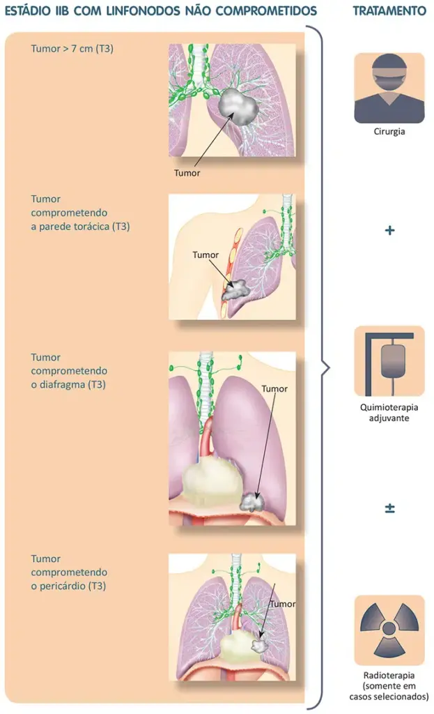Tratamento do câncer de pulmão