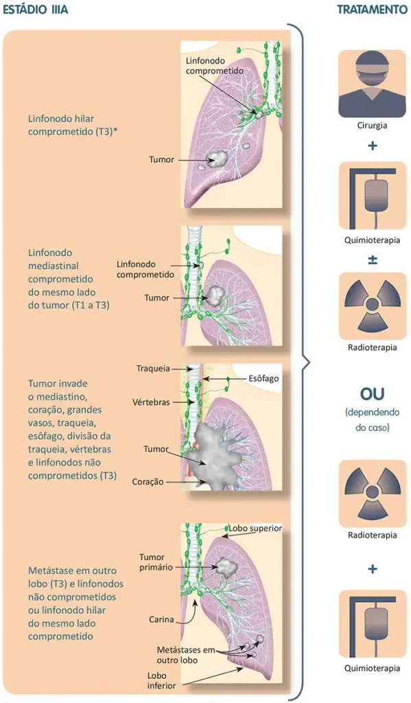 Tratamento do câncer de pulmão