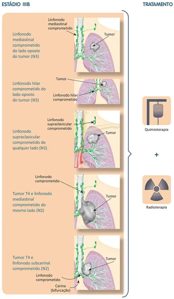 Tratamento do câncer de pulmão