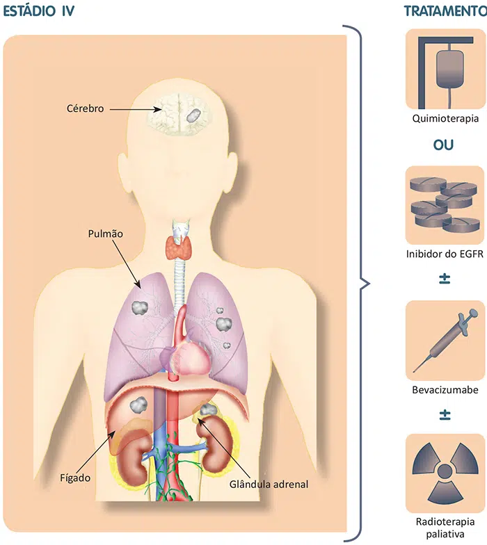 Tratamento do câncer de pulmão