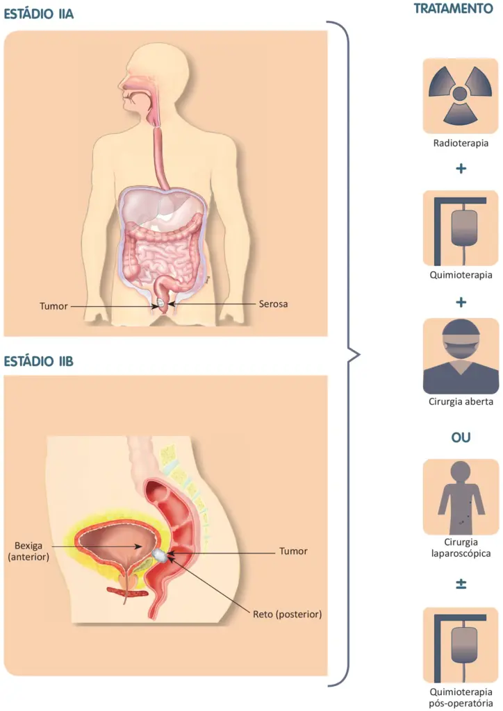 Tratamento do câncer colorretal