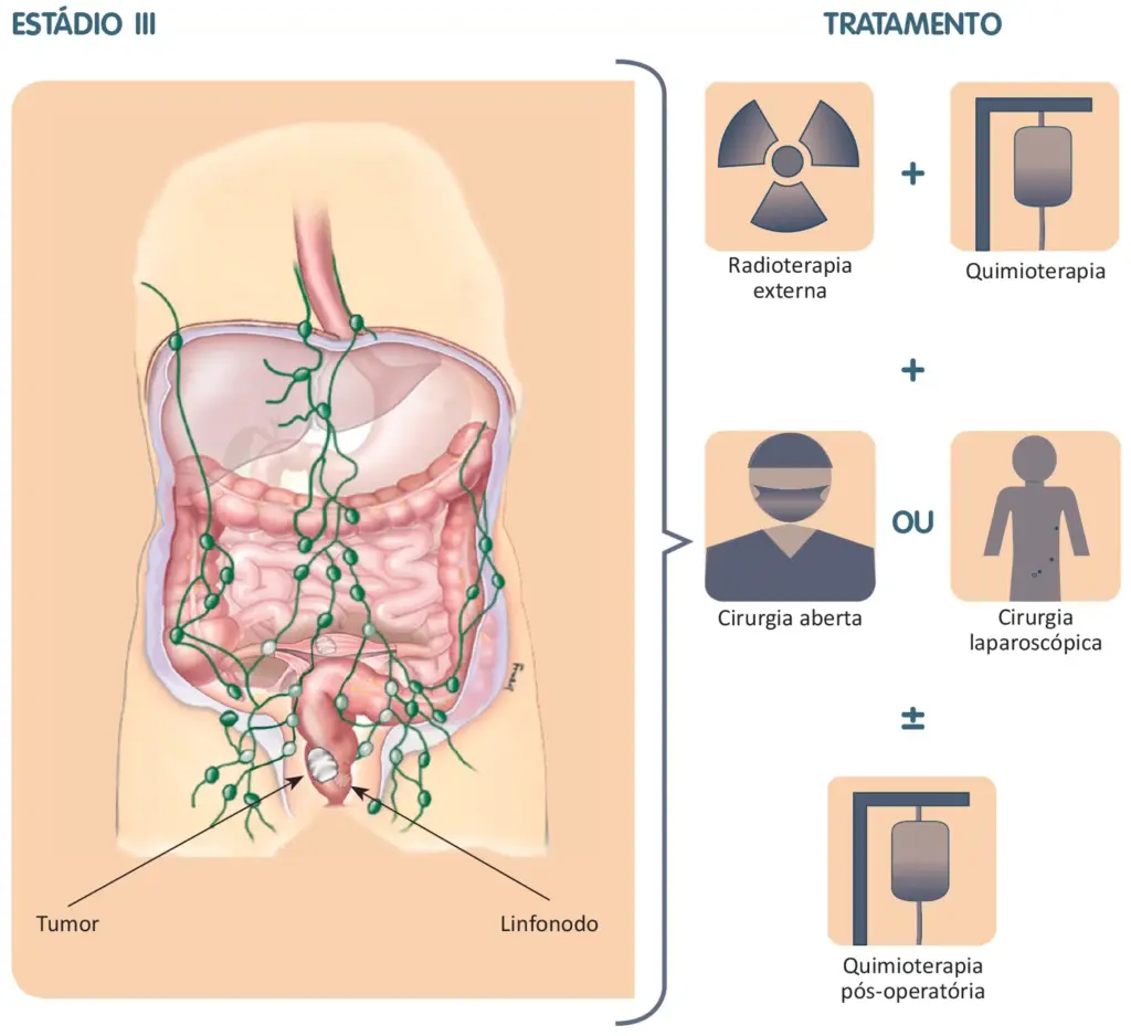 Tratamento do câncer colorretal