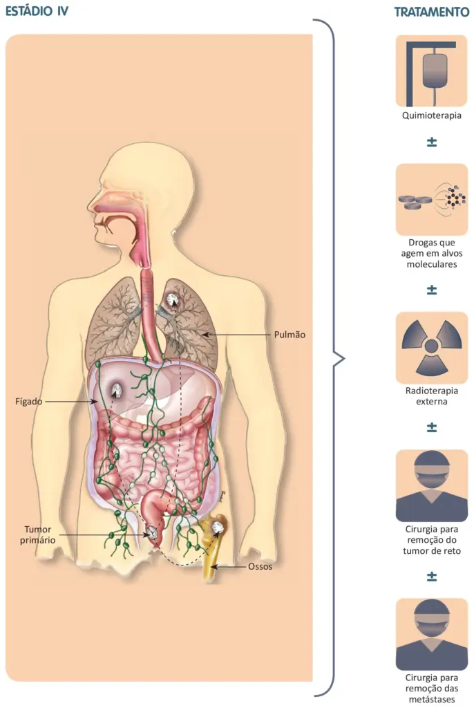 Tratamento do câncer colorretal
