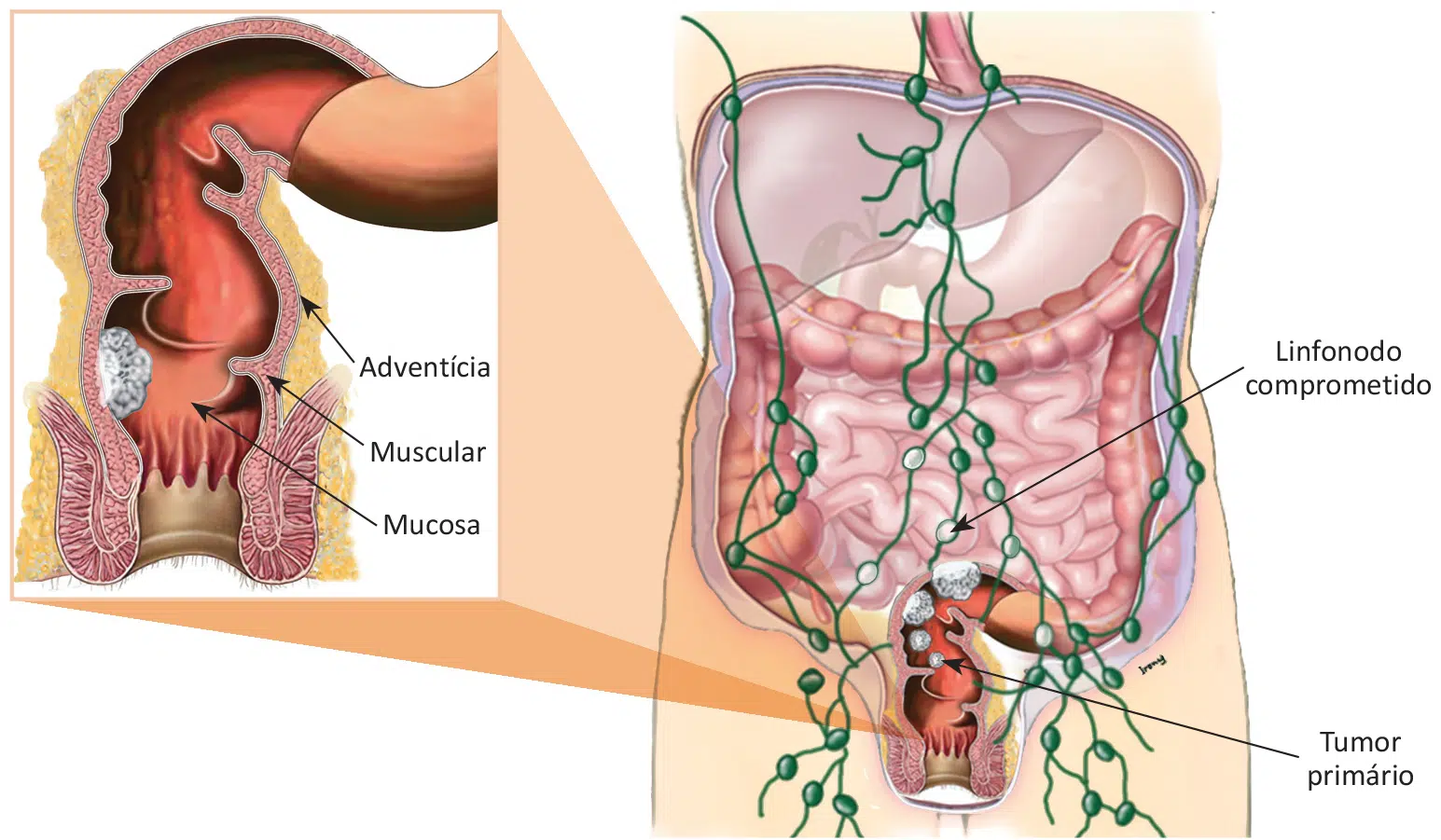 Crescimento local e regional do câncer colorretal.
