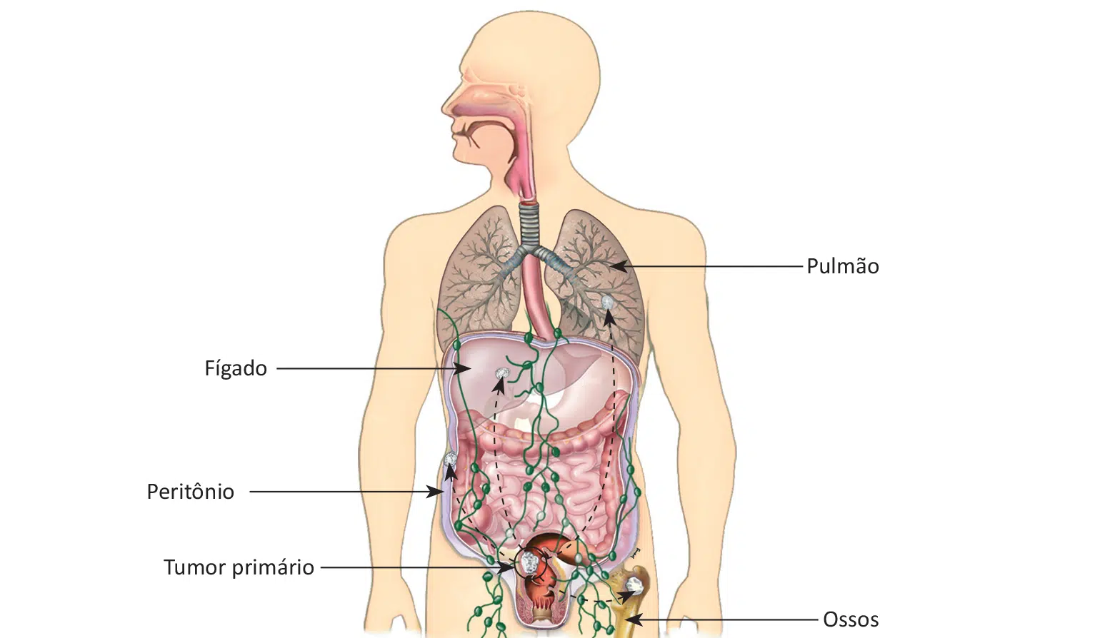 Crescimento à distância do câncer colorretal.