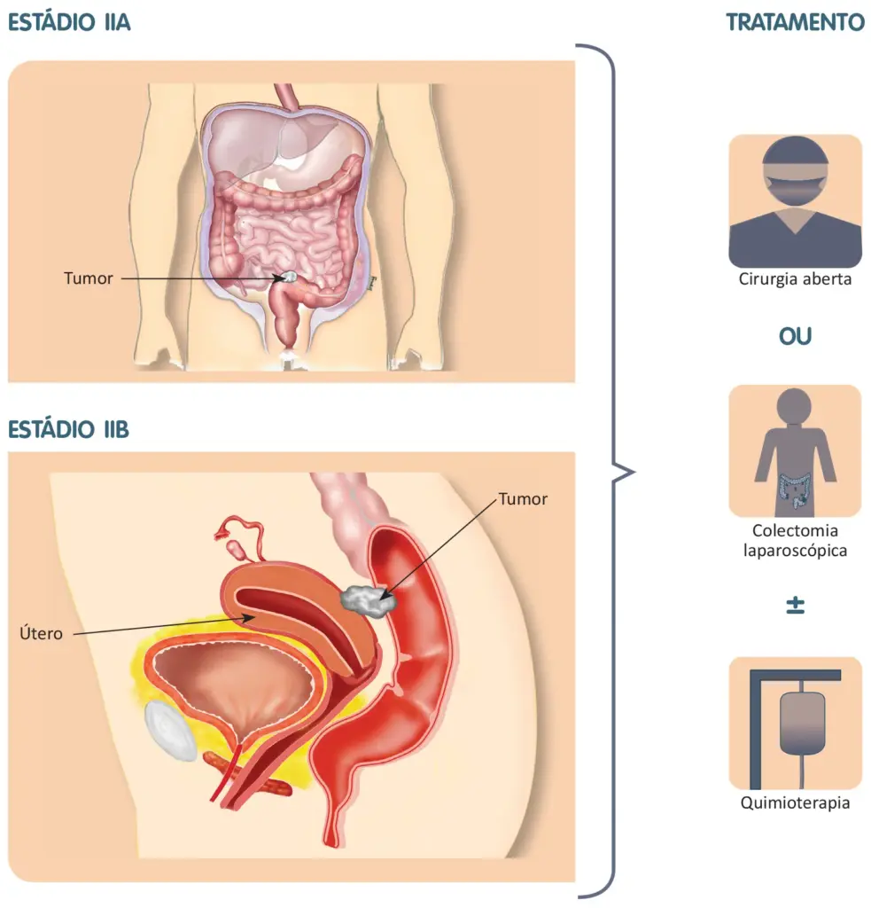 Tratamento do câncer colorretal