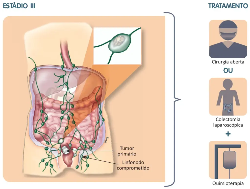 Tratamento do câncer colorretal
