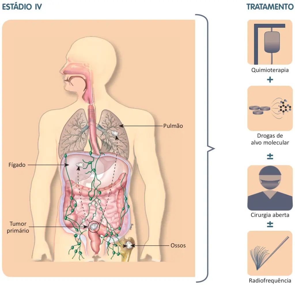 Tratamento do câncer colorretal