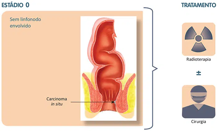 Tratamento do câncer do canal anal