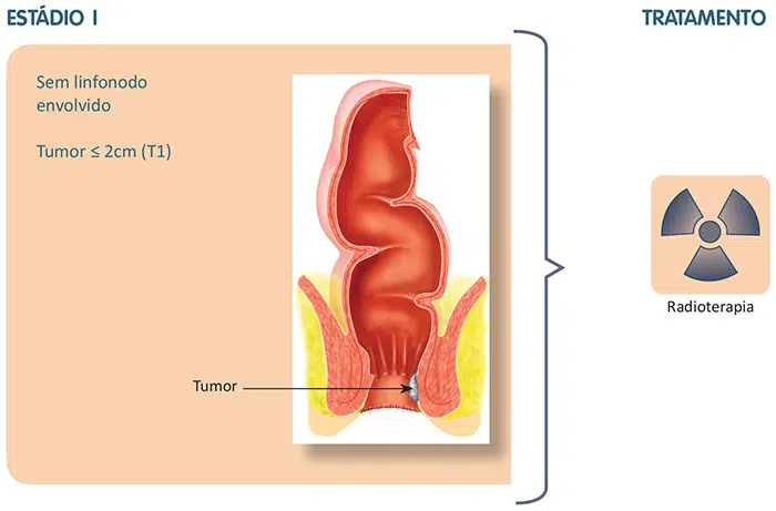 Tratamento do câncer do canal anal