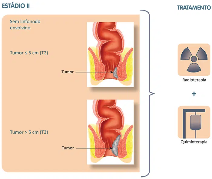 Tratamento do câncer do canal anal