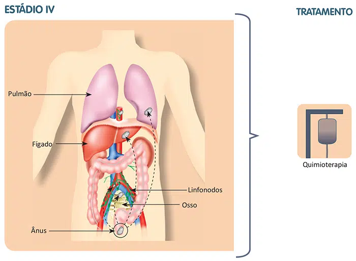 Tratamento do câncer do canal anal