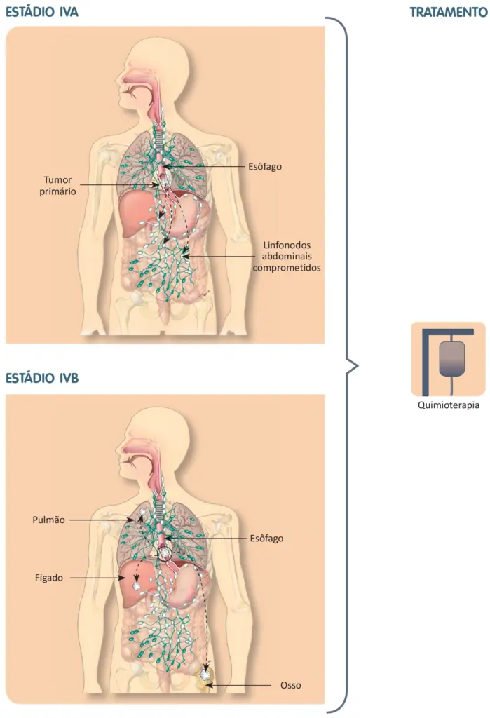 Tratamento do câncer de esôfago