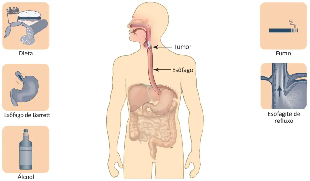 Fatores de risco do câncer de esôfago