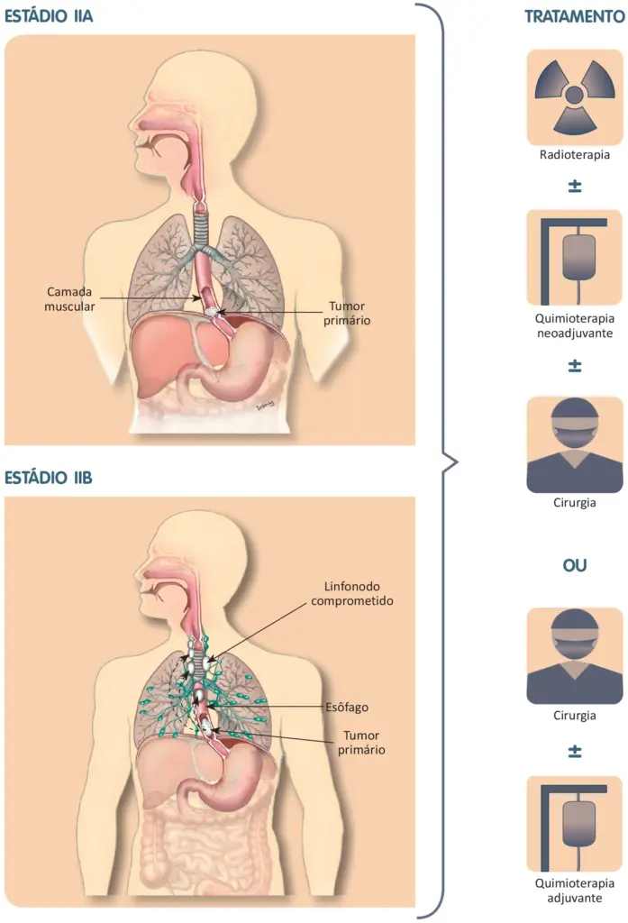 Tratamento do câncer de esôfago