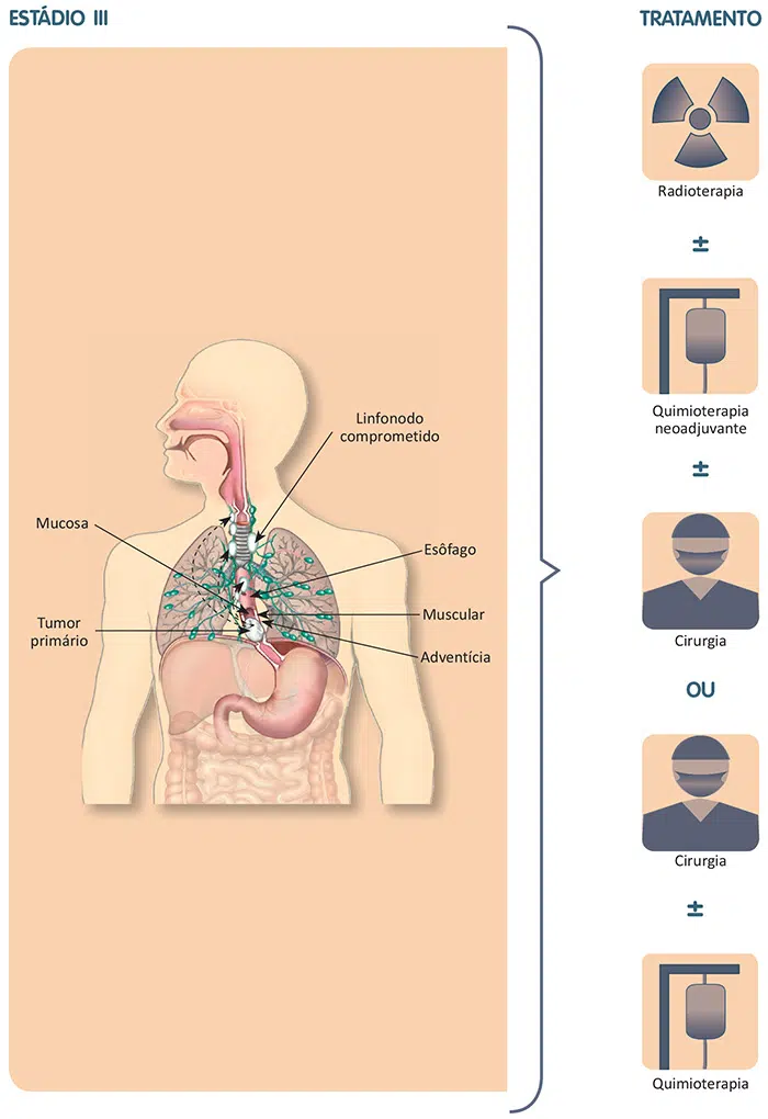 Tratamento do câncer de esôfago