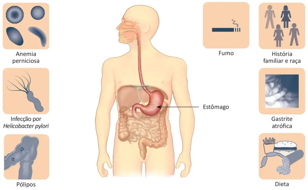 Fatores de risco do câncer de estômago