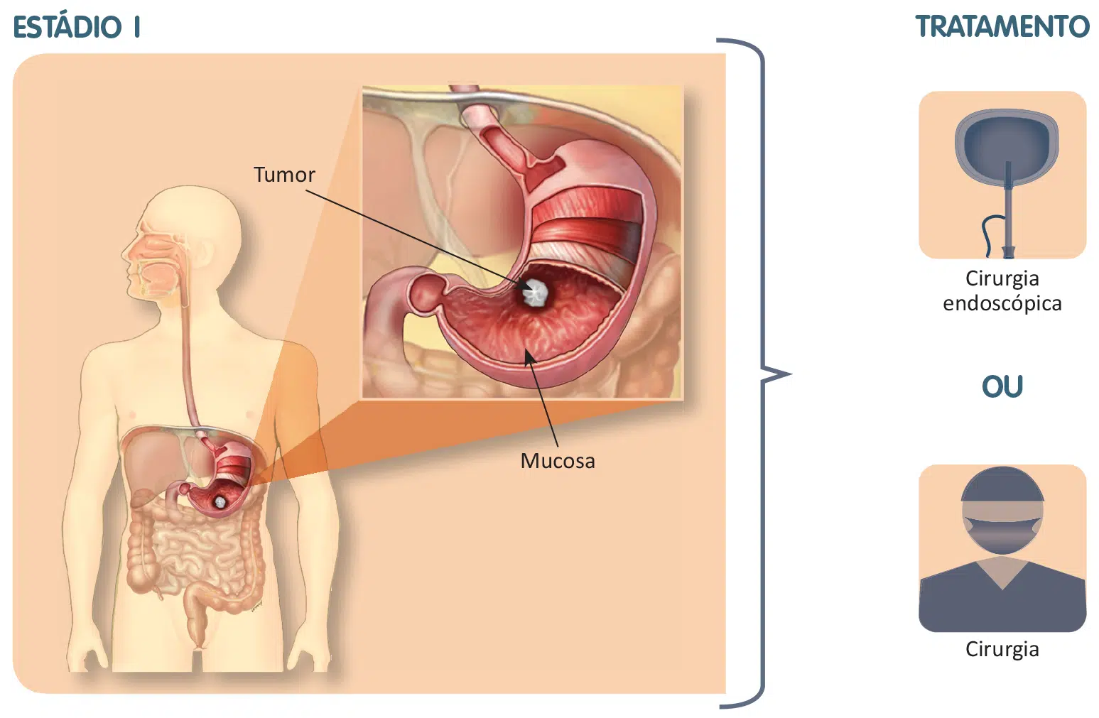 Tumor confinado ao estômago