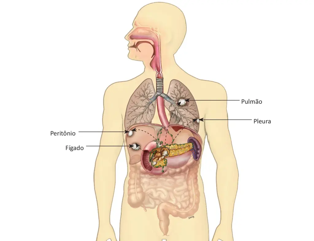 O que é câncer de pâncreas?