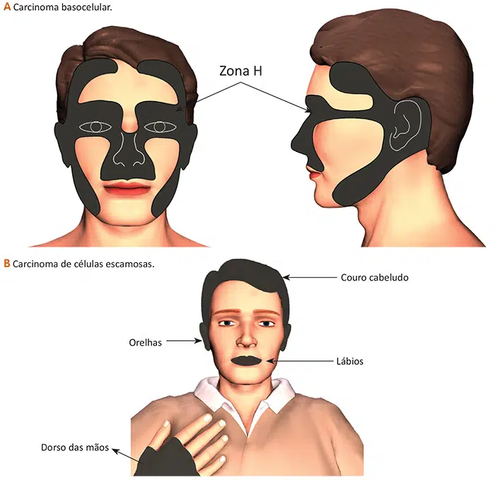 O que é câncer de pele (melanoma e não melanoma)?