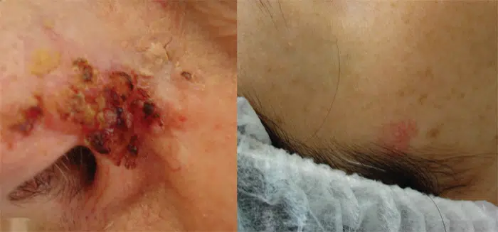Sintomas do câncer de pele (melanoma e não melanoma)