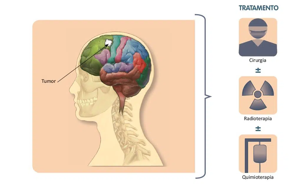 Tratamento do câncer de cérebro