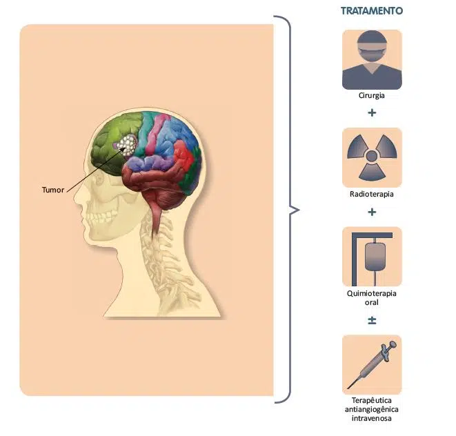 Tratamento do câncer de cérebro