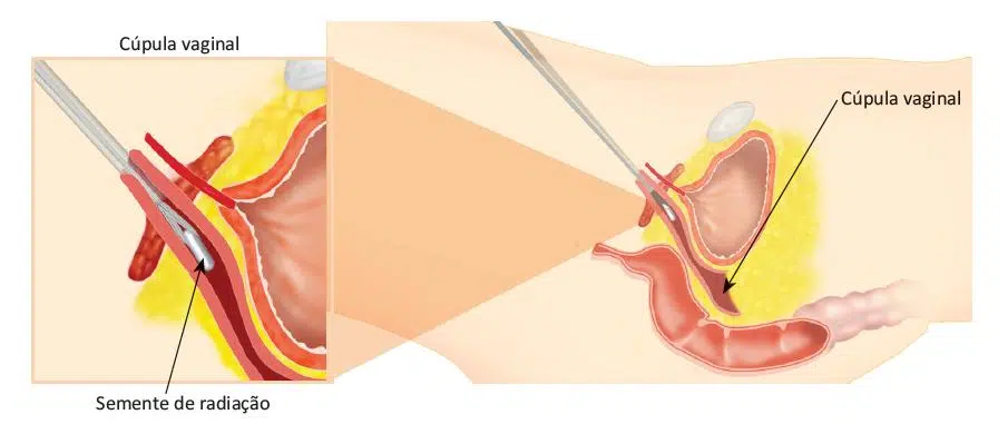 Tratamento do câncer de endométrio